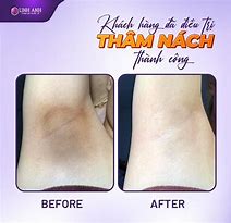 Review Trị Thâm Nách Api Tại Nhà Của Mỹ